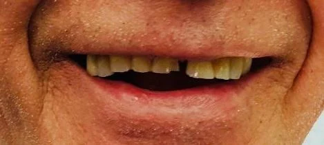 Klinička fotografija zubi prije početka terapije