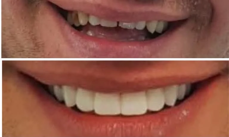 Klinička fotografija osmijeha prije terapije