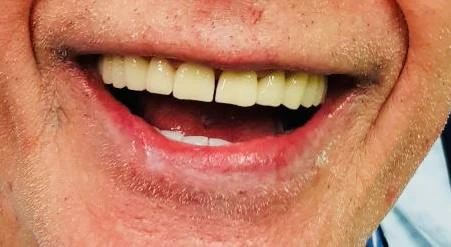 Klinička fotografija zubi nakon dovršene terapije
